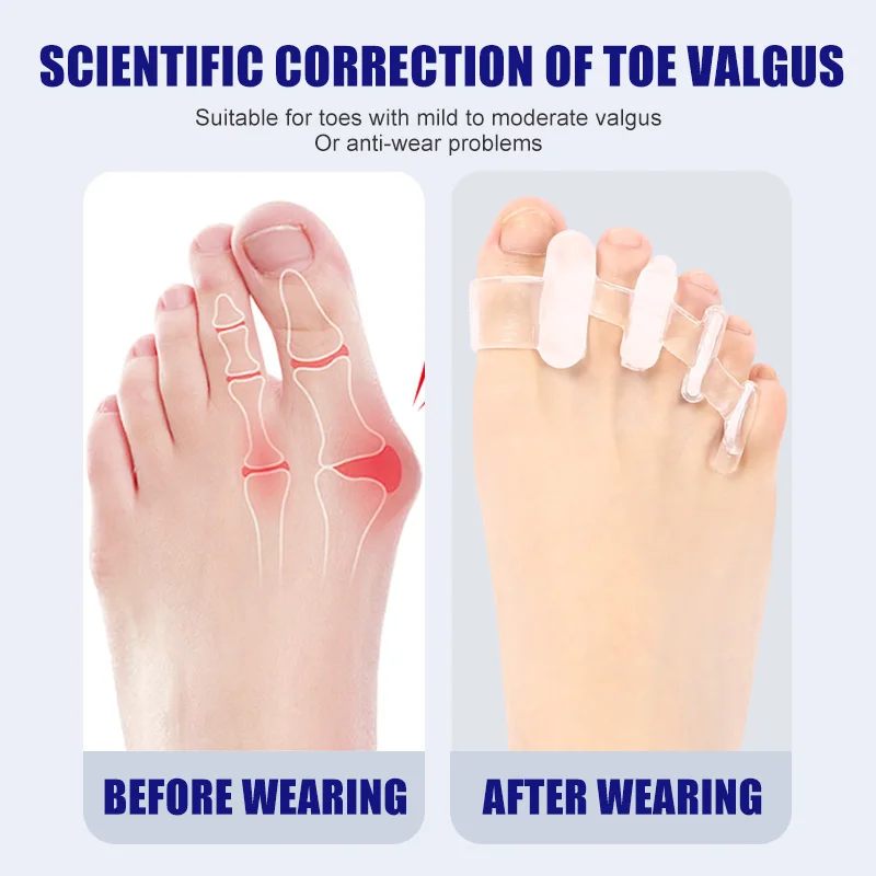 1 ペアシリコンつま先セパレーター腱膜瘤コレクターハンマーつ - Toe Separator Silicon のレビューと価格